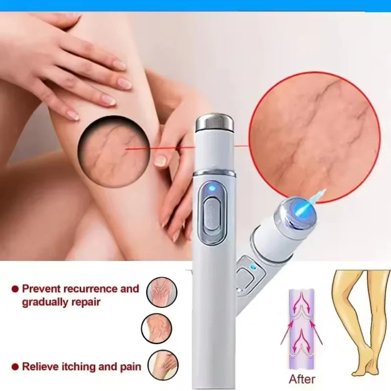 Varicose veins laser pen
