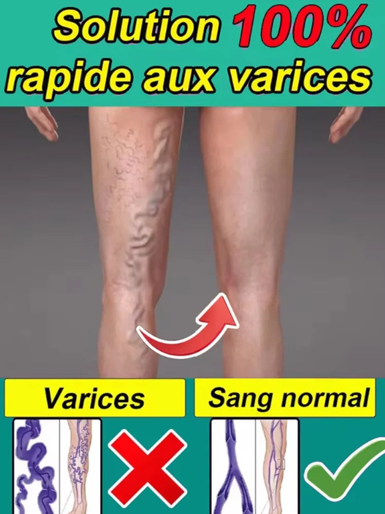Varicose veins laser pen